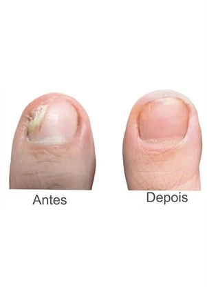 Lar e Lazer - Micozione Fortalecedor e Reparador de Unhas - LAR E LAZER